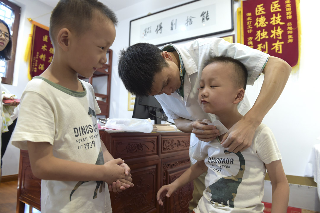 2018年7月17日,浙江省义乌市一家中医医院,一个孩子接受针灸治疗。